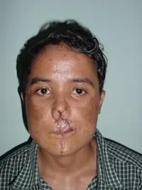 Volunteer Reconstructive Surgery - Case 273 - After