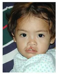 Volunteer Reconstructive Surgery - Case 323 - Before