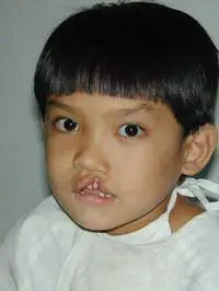 Volunteer Reconstructive Surgery - Case 320 - Before