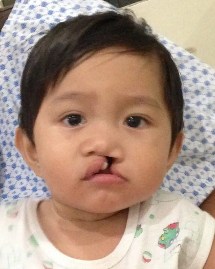 Volunteer Reconstructive Surgery - Case 1487 - Before