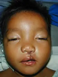 Volunteer Reconstructive Surgery - Case 293 - After