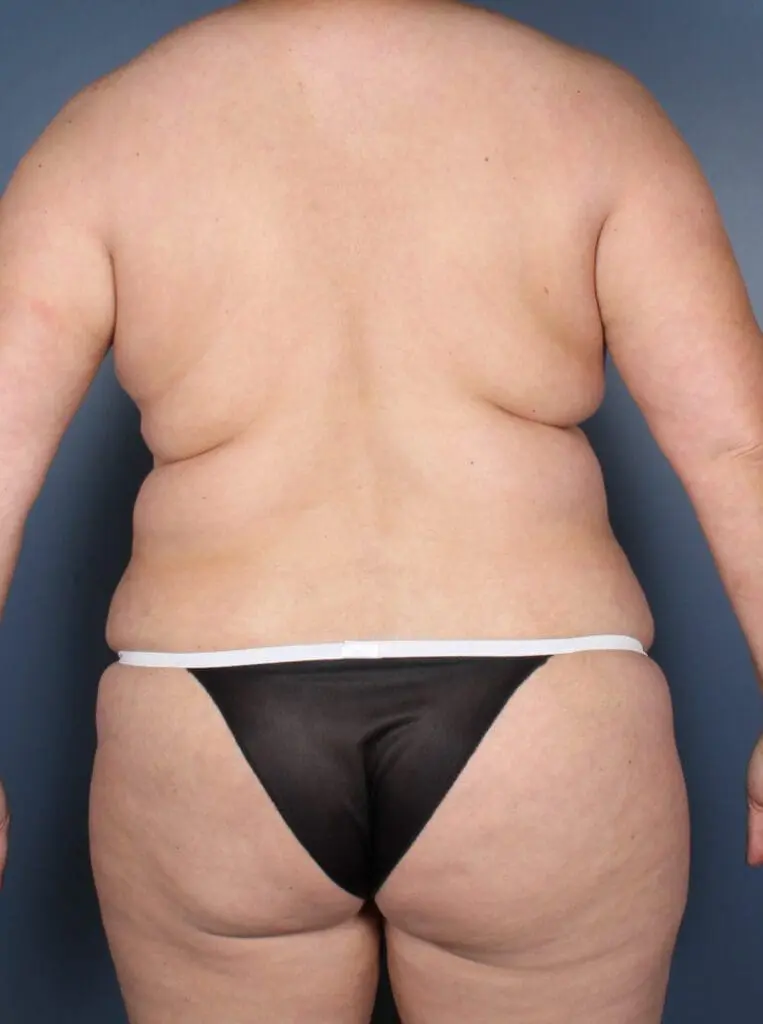 Liposuction - Case 1475 - Before