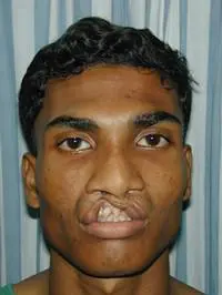 Volunteer Reconstructive Surgery - Case 289 - Before