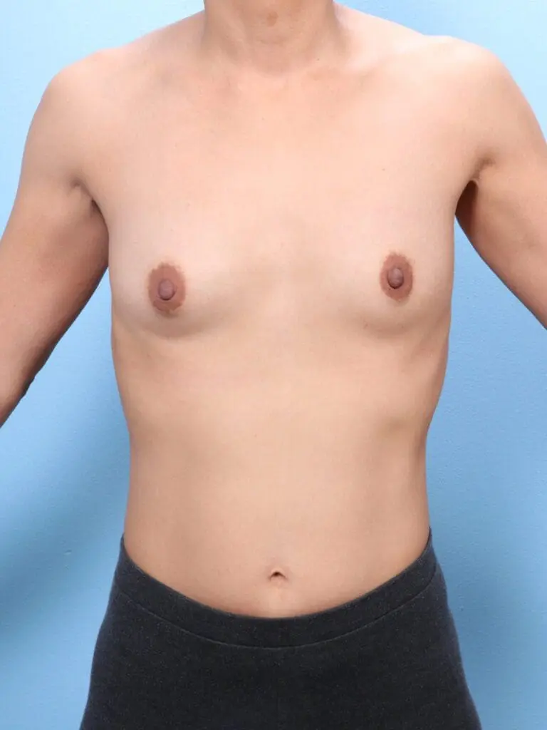 Breast Augmentation - Case 1839 - Before