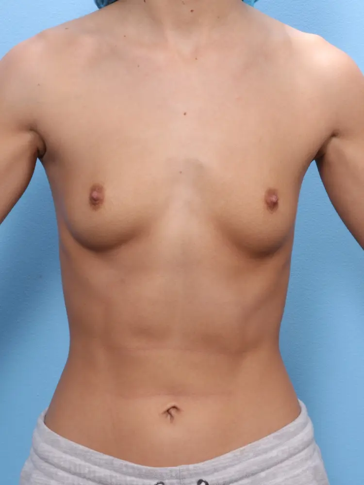 Breast Augmentation - Case 1841 - Before