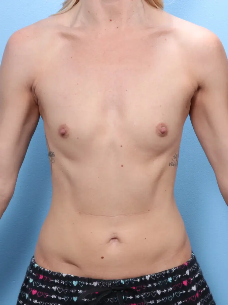 Breast Augmentation - Case 1843 - Before