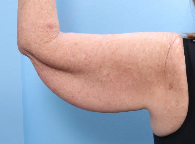 Arm Lift - Case 1846 - Before