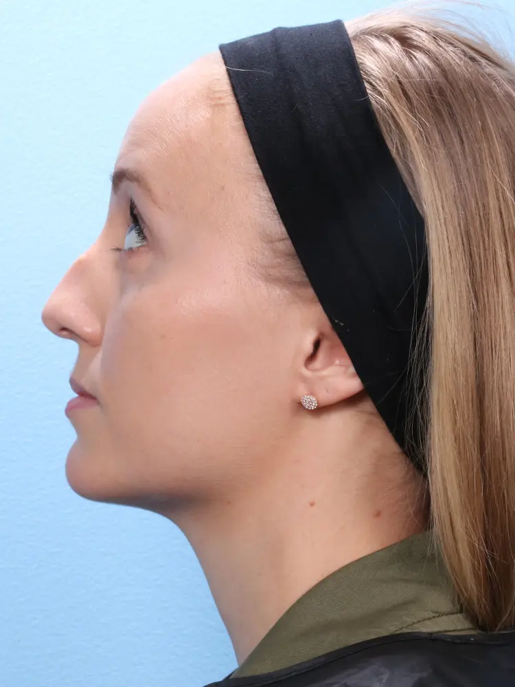 Rhinoplasty - Case 1847 - Before