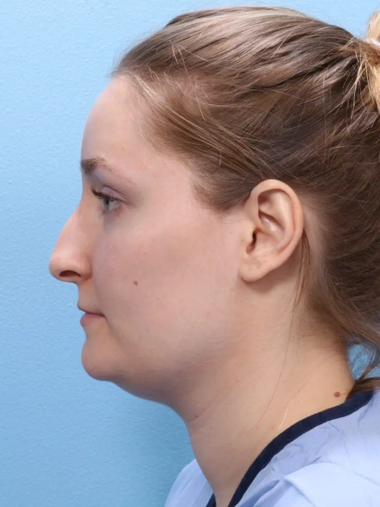 Rhinoplasty - Case 1831 - Before