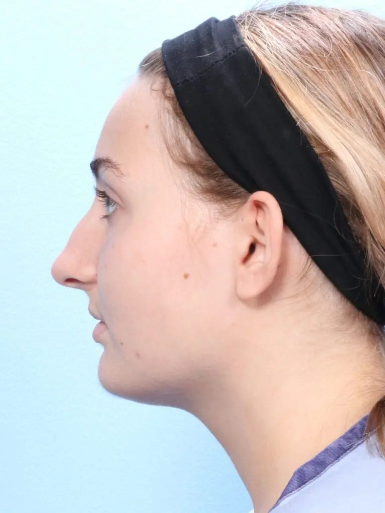 Rhinoplasty - Case 1832 - Before