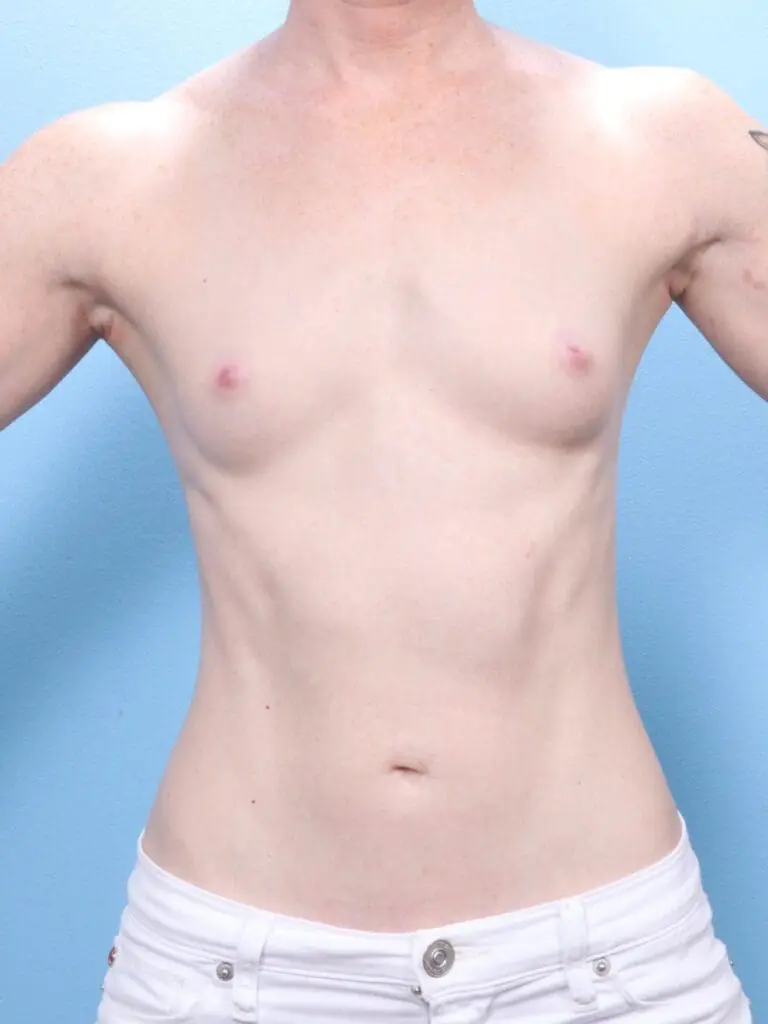 Breast Augmentation - Case 1834 - Before