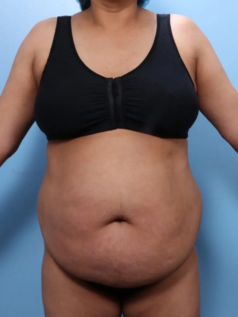 Tummy Tuck - Case 1829 - Before