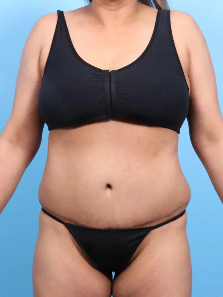 Tummy Tuck - Case 1829 - After