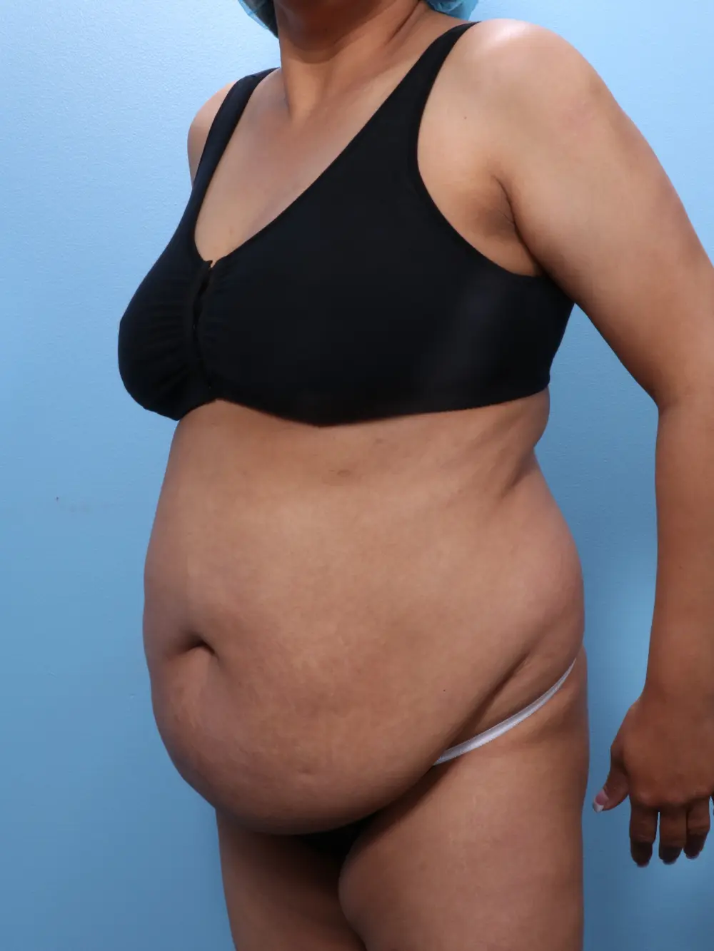 Tummy Tuck Patient Photo - Case 1829 - before view-1