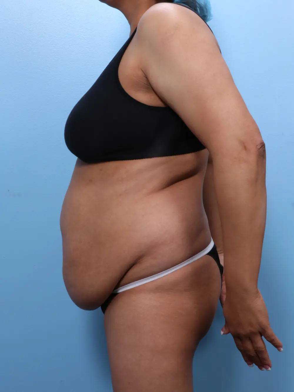 Tummy Tuck Patient Photo - Case 1829 - before view-2