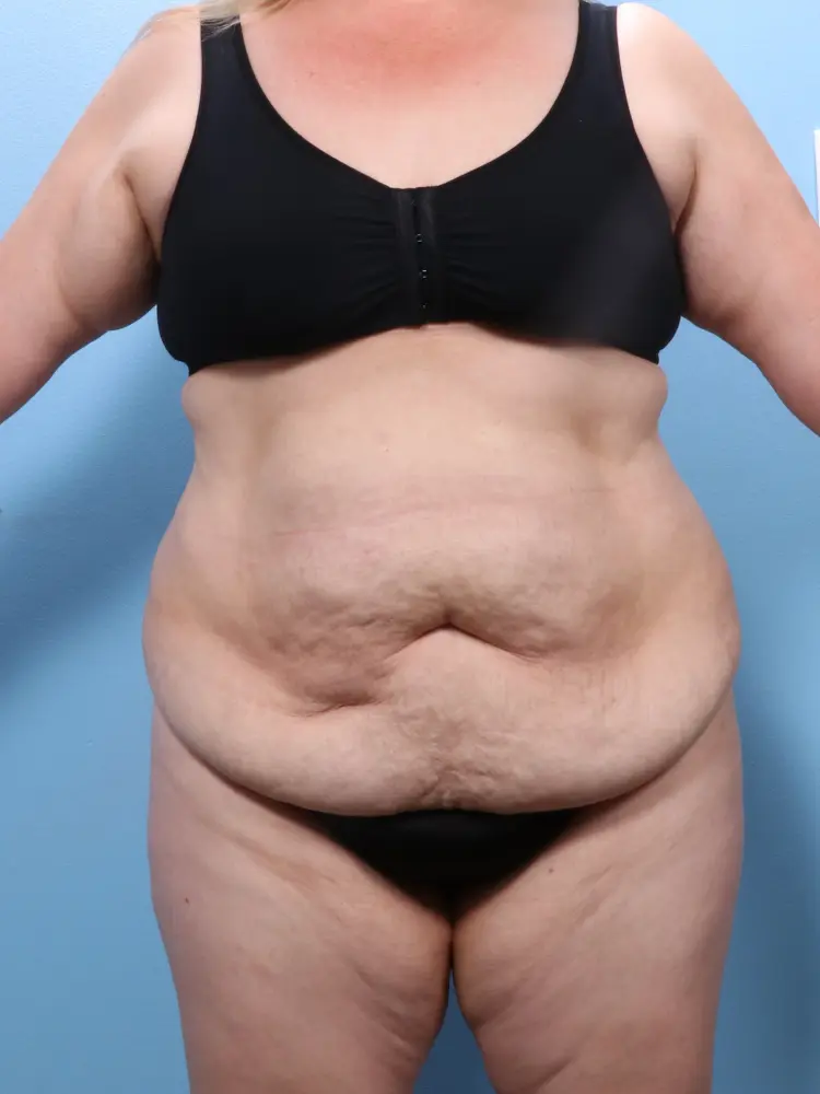 Tummy Tuck - Case 1844 - Before