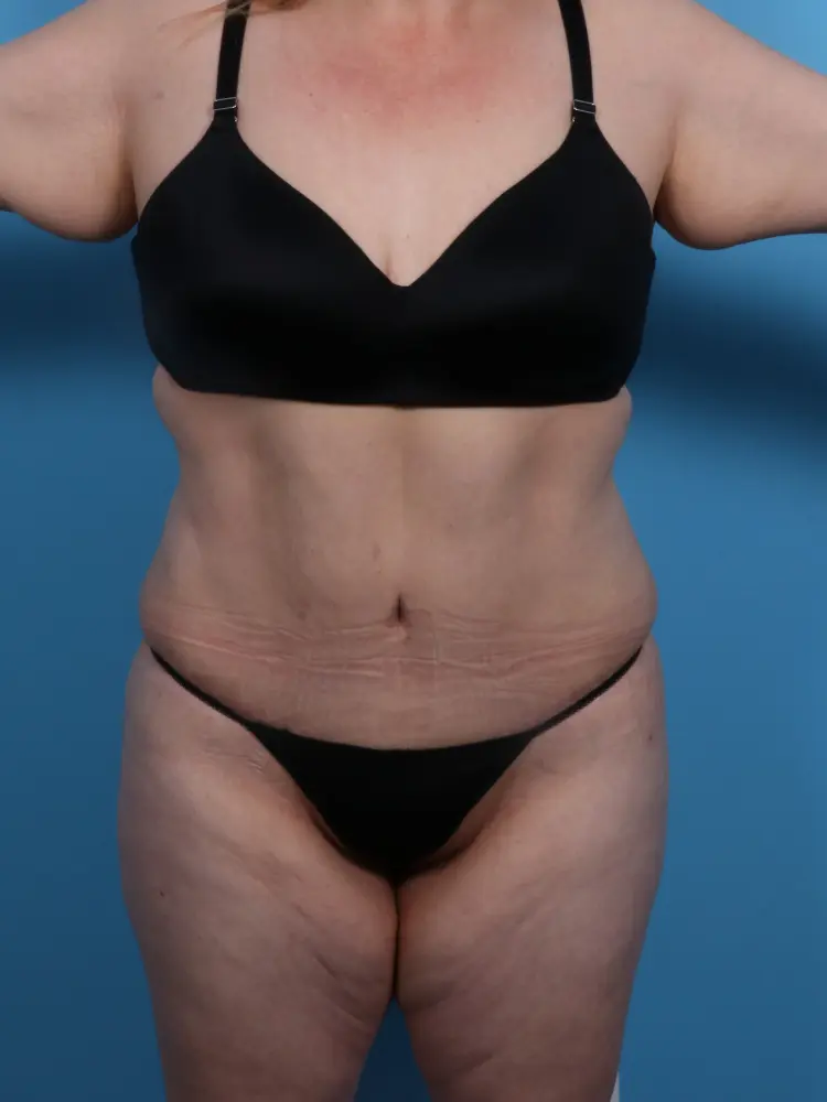 Tummy Tuck - Case 1844 - After