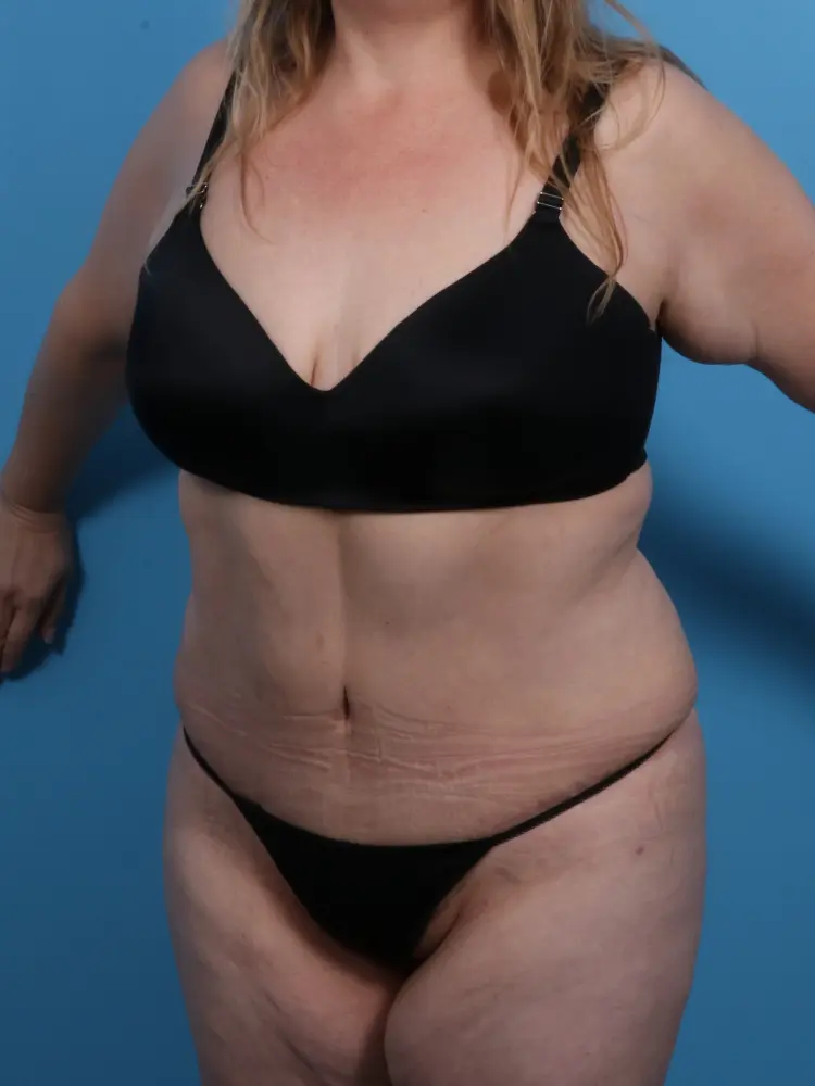 Tummy Tuck Patient Photo - Case 1844 - after view-1