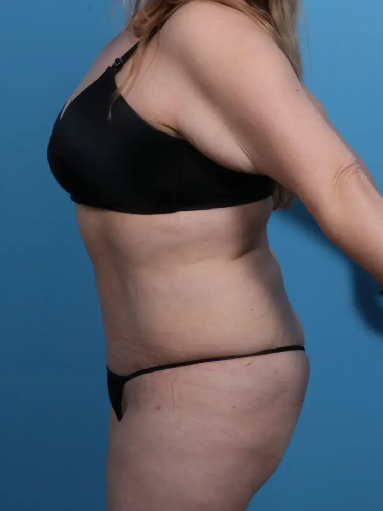 Tummy Tuck Patient Photo - Case 1844 - after view-2