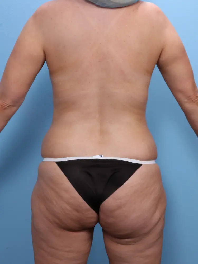 Tummy Tuck Patient Photo - Case 1848 - before view-2