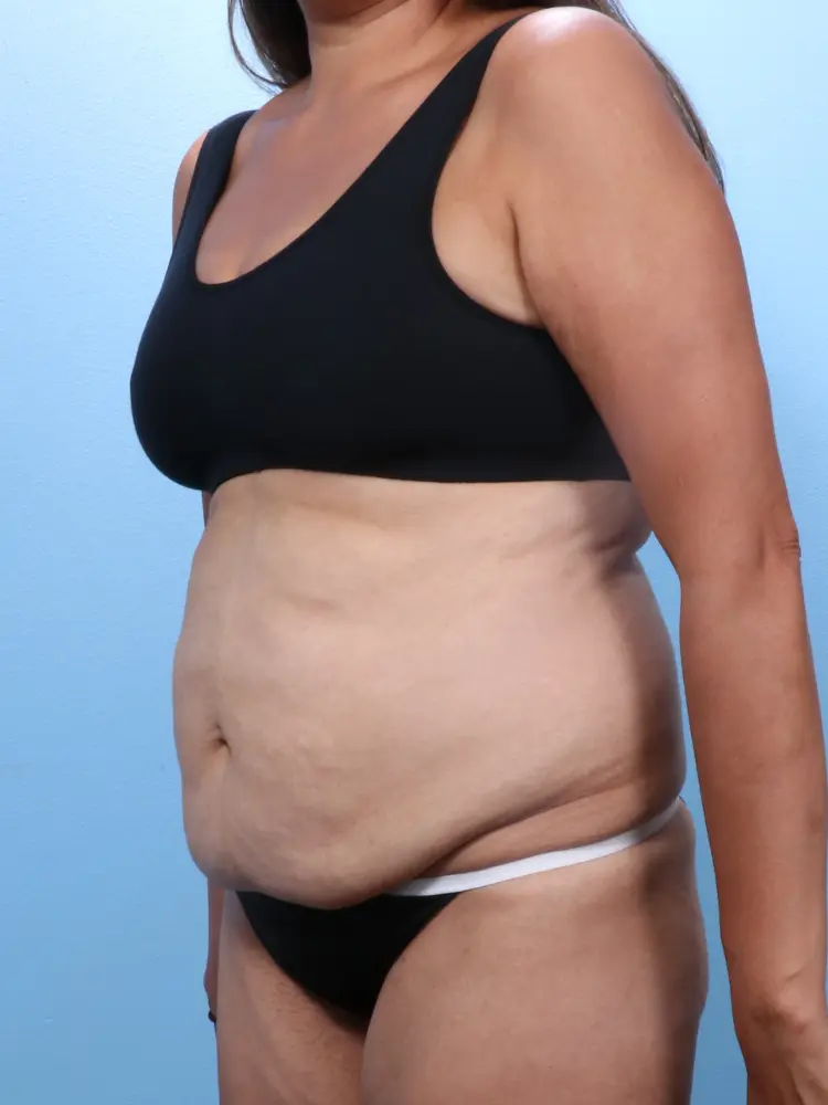 Tummy Tuck Patient Photo - Case 1852 - before view-1