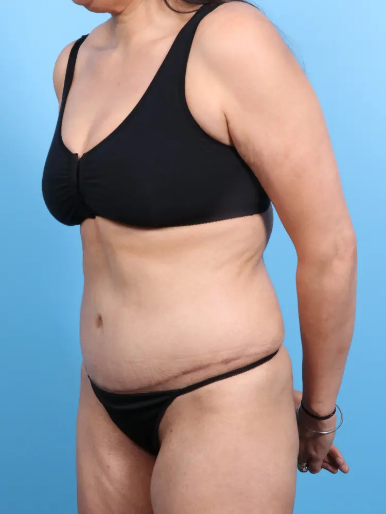 Tummy Tuck Patient Photo - Case 1852 - after view-1
