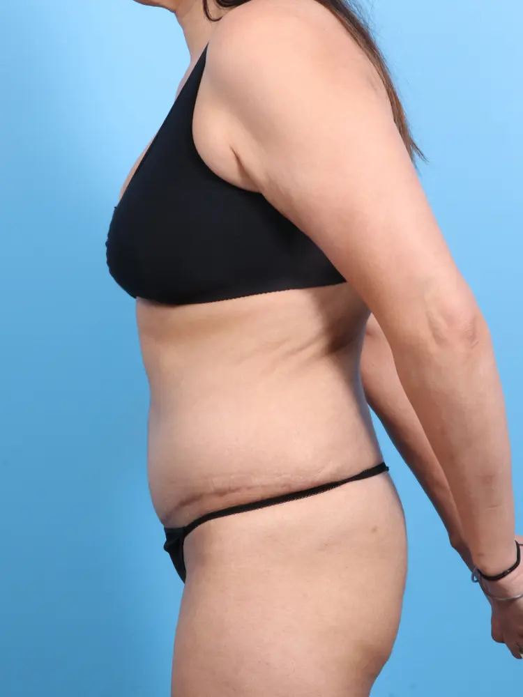 Tummy Tuck Patient Photo - Case 1852 - after view-2
