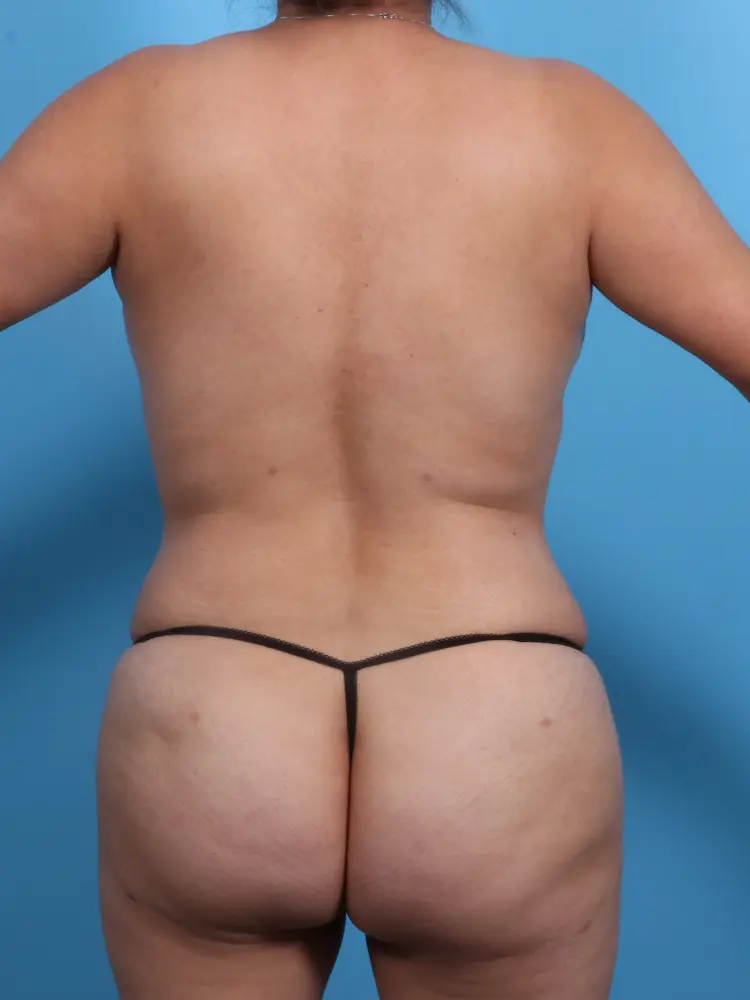 Tummy Tuck Patient Photo - Case 1854 - after view-3