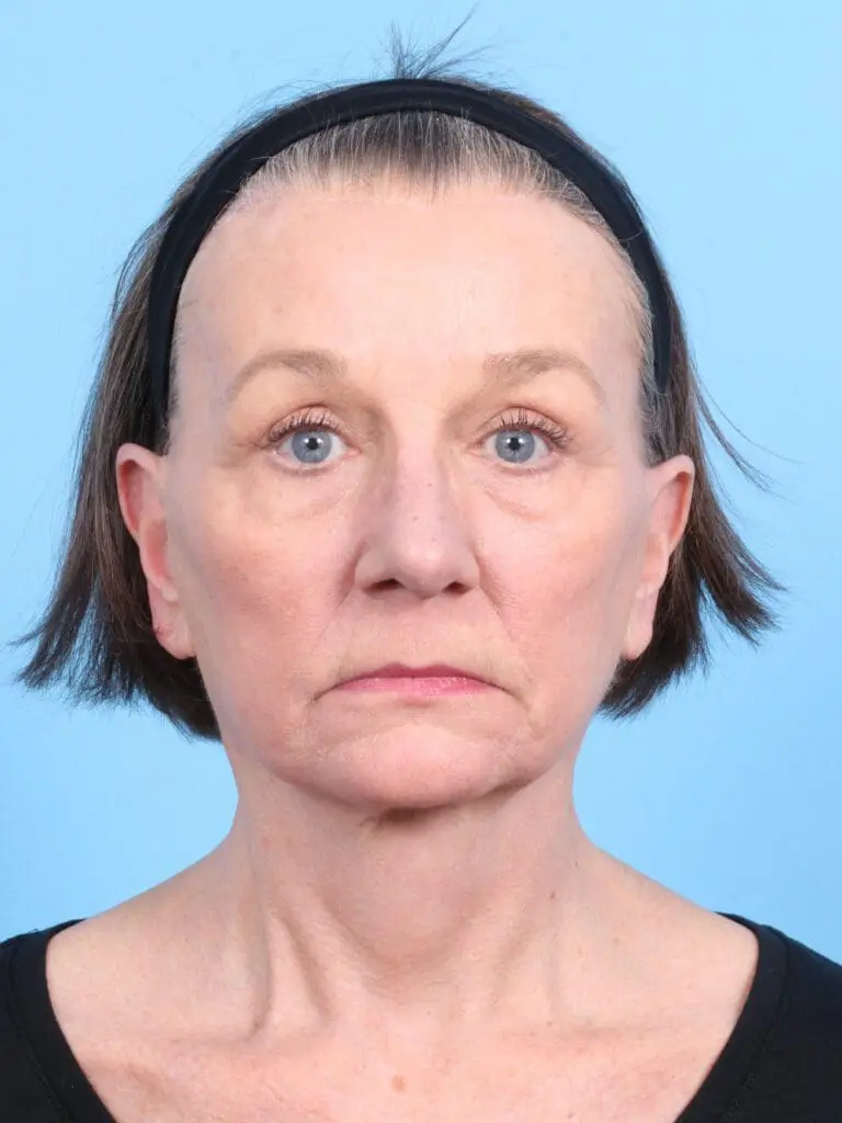 Brow Lift - Case 1857 - After