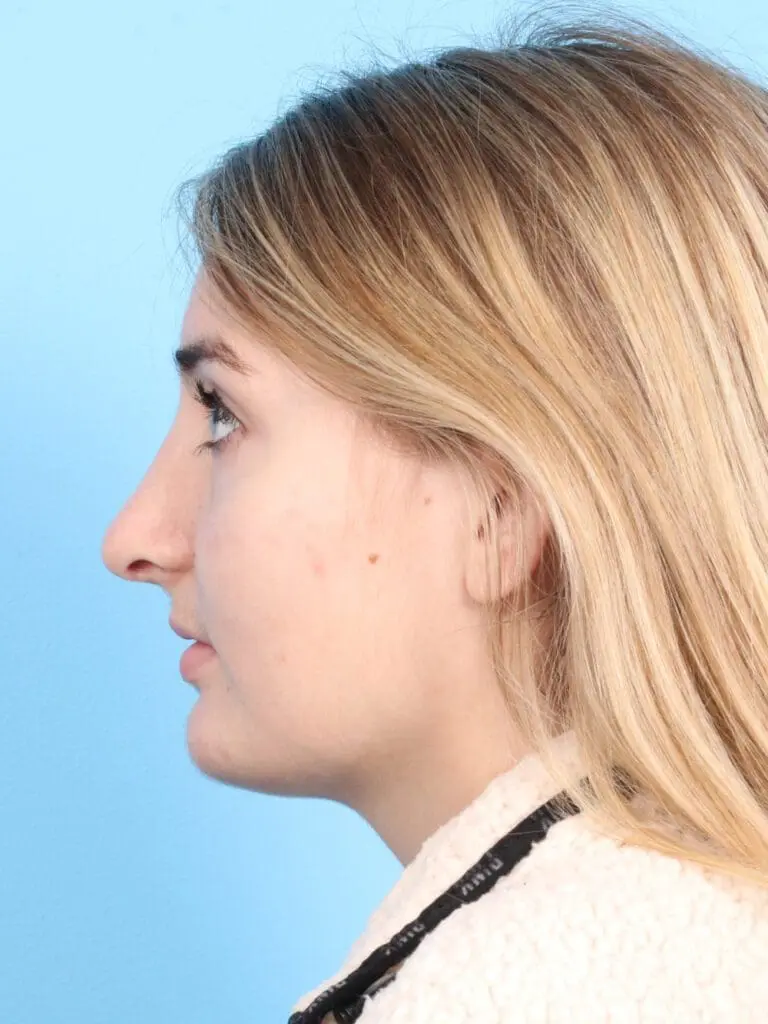 Rhinoplasty - Case 1832 - After