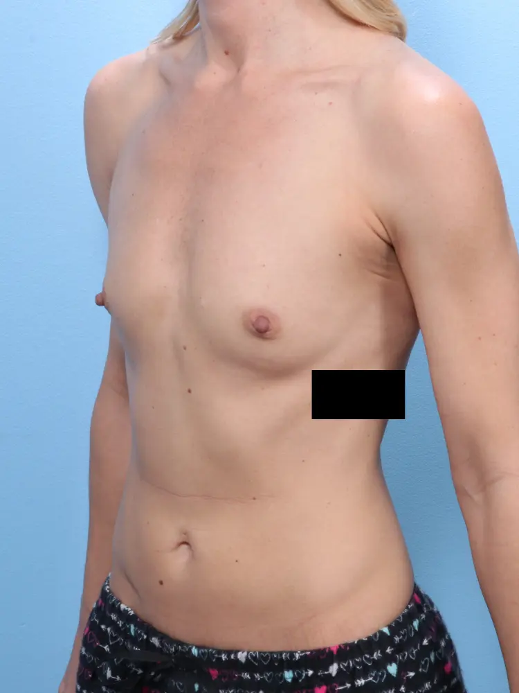 Breast Augmentation Patient Photo - Case 1843 - before view-1