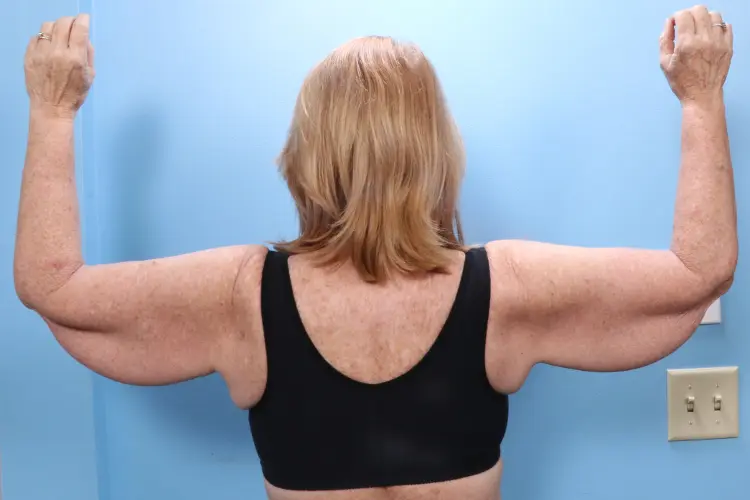 Arm Lift Patient Photo - Case 1846 - before view-1