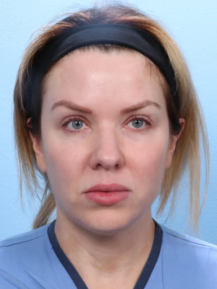 Rhinoplasty Patient Photo - Case 1849 - before view-1