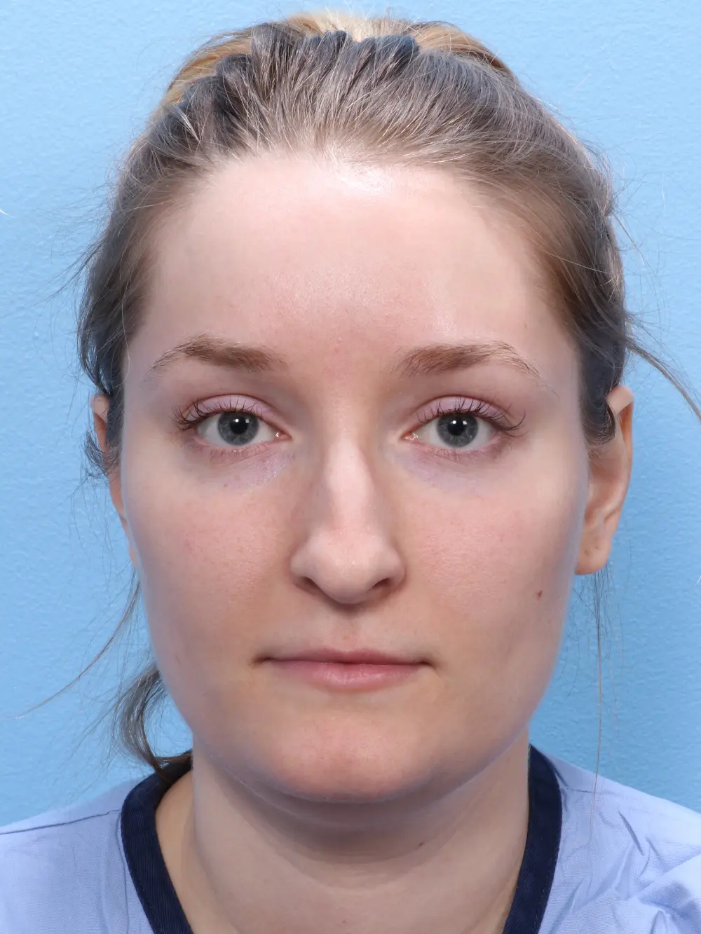 Rhinoplasty Patient Photo - Case 1831 - before view-1