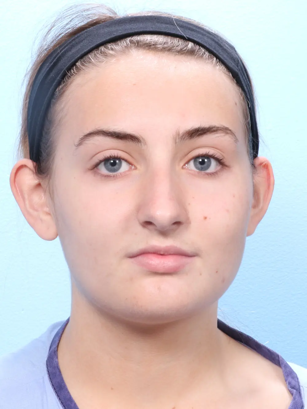 Rhinoplasty Patient Photo - Case 1832 - before view-1