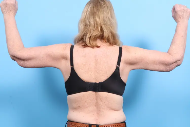 Arm Lift Patient Photo - Case 1846 - after view-1