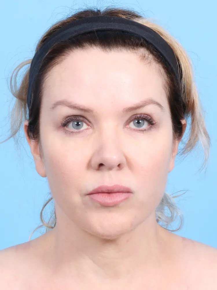 Rhinoplasty Patient Photo - Case 1849 - after view-1