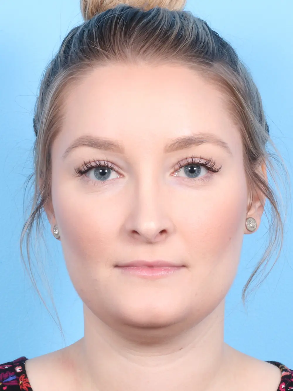 Rhinoplasty Patient Photo - Case 1831 - after view-1