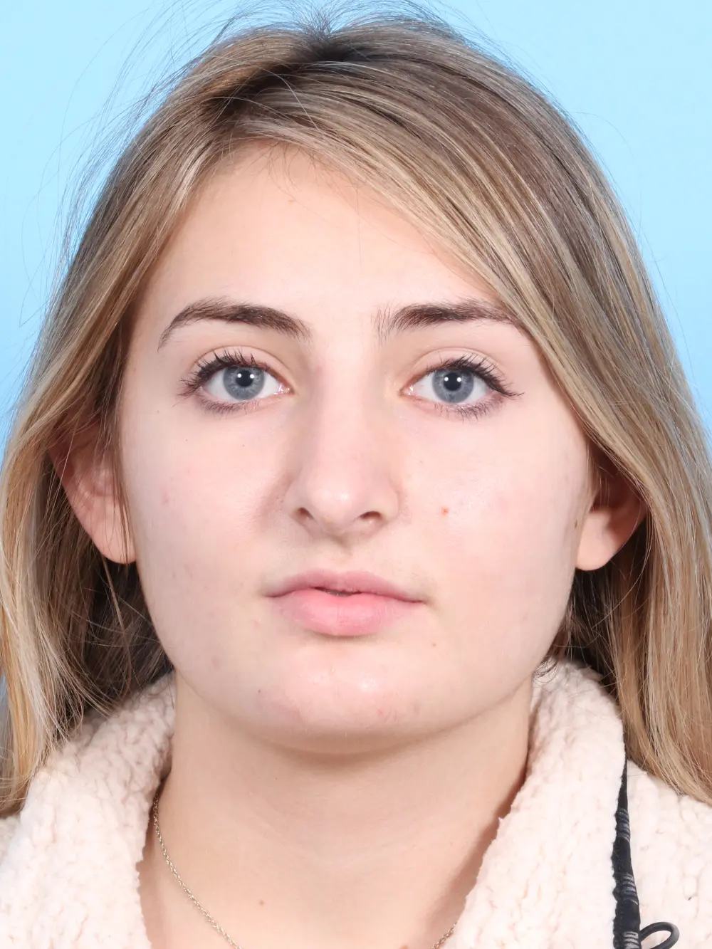 Rhinoplasty Patient Photo - Case 1832 - after view-1