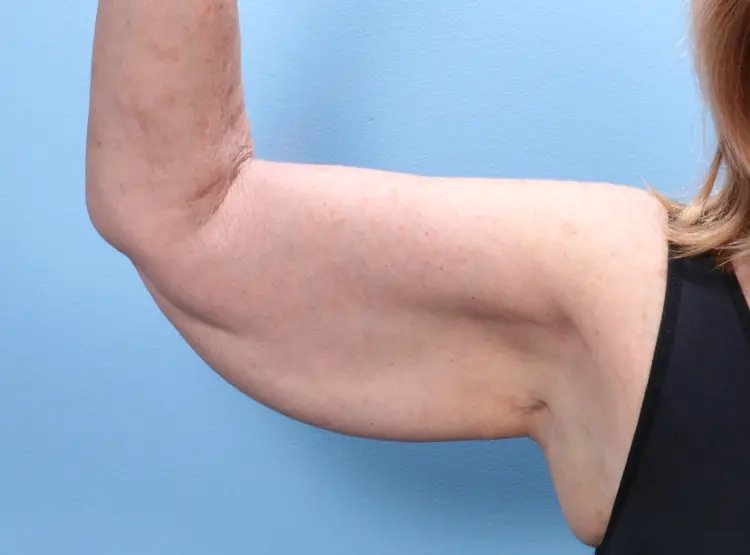 Arm Lift Patient Photo - Case 1846 - before view-2