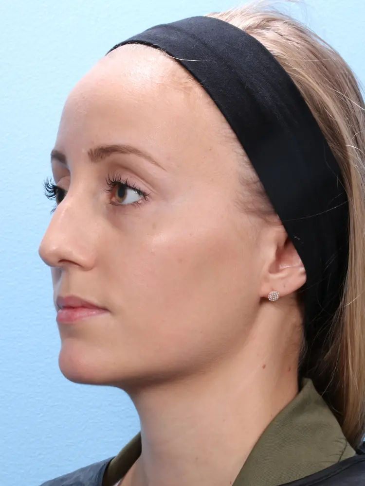 Rhinoplasty Patient Photo - Case 1847 - before view-2