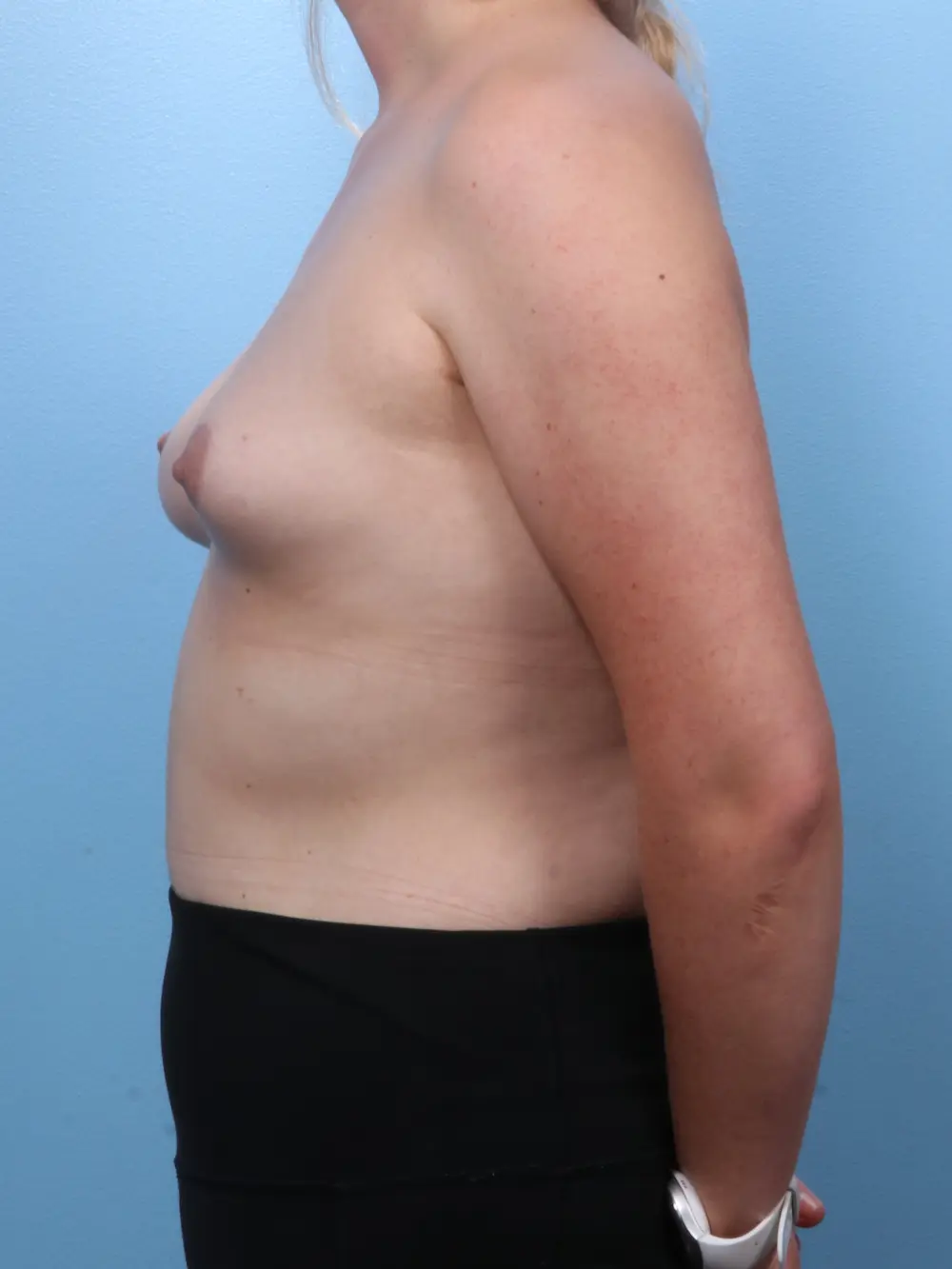 Breast Augmentation Patient Photo - Case 1828 - before view-2