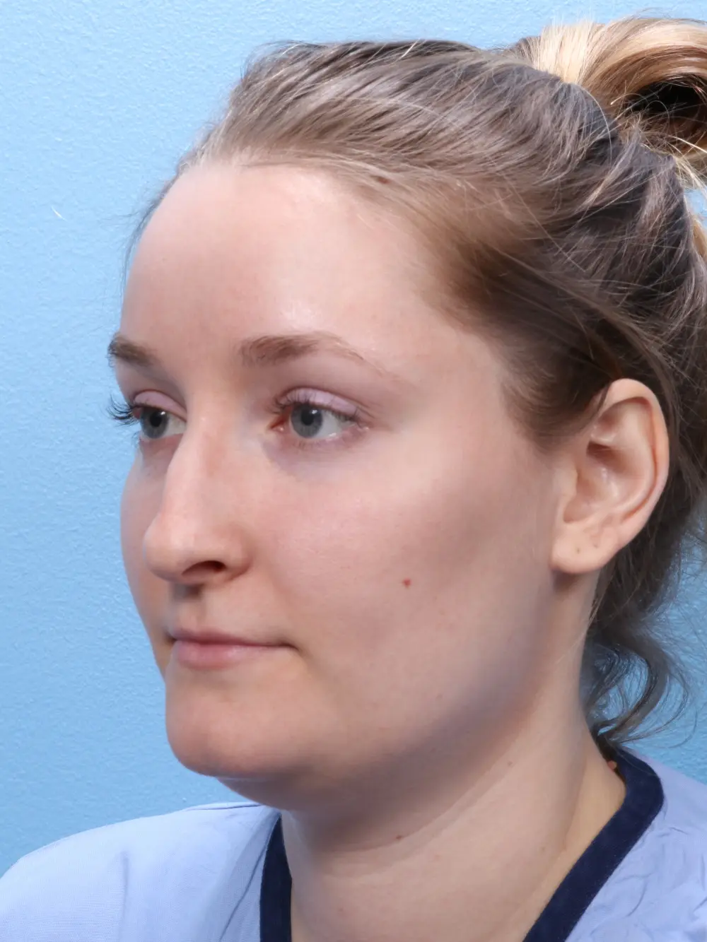 Rhinoplasty Patient Photo - Case 1831 - before view-2