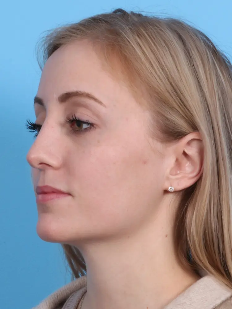 Rhinoplasty Patient Photo - Case 1847 - after view-2