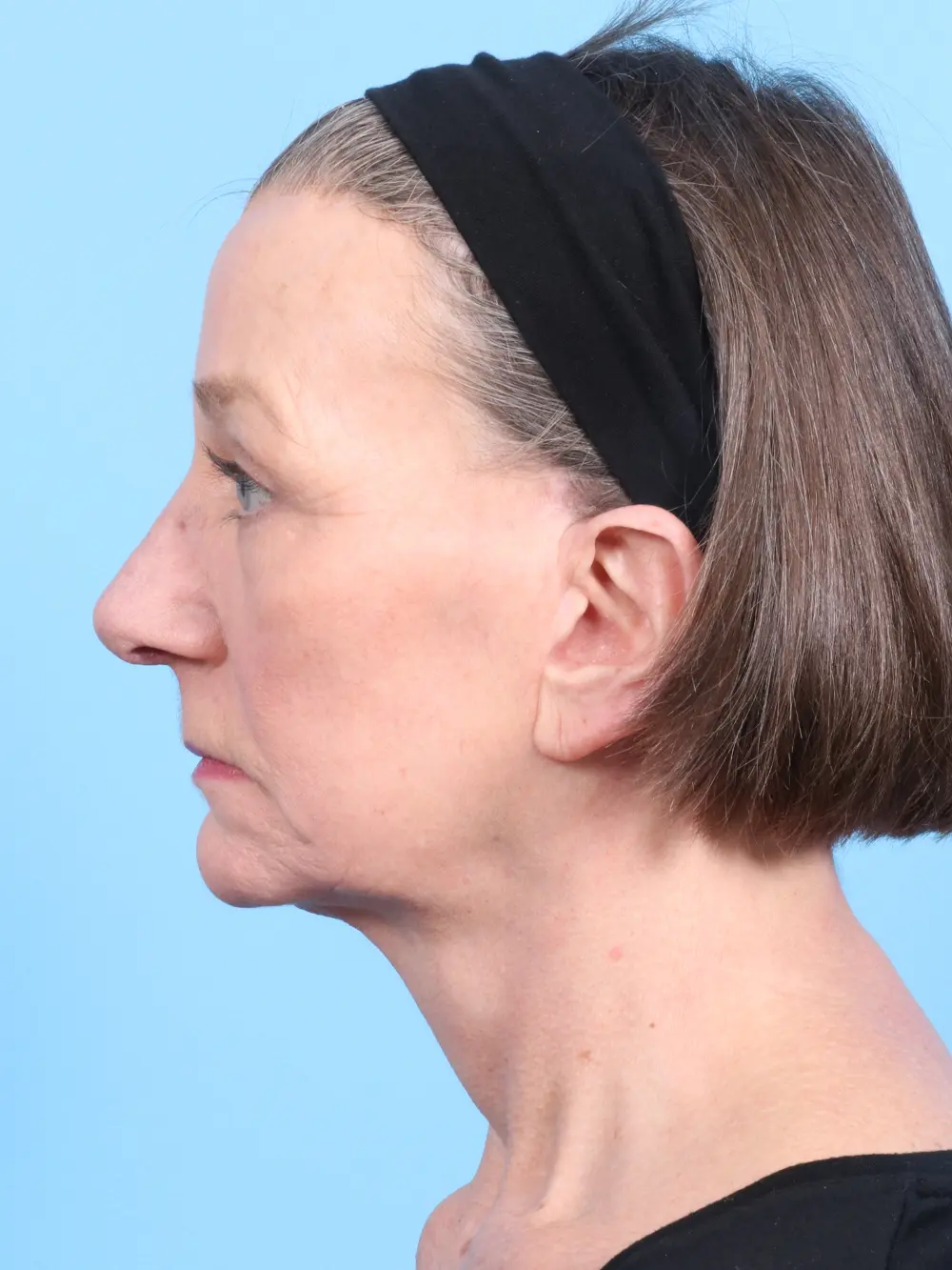 Brow Lift Patient Photo - Case 1857 - after view-2