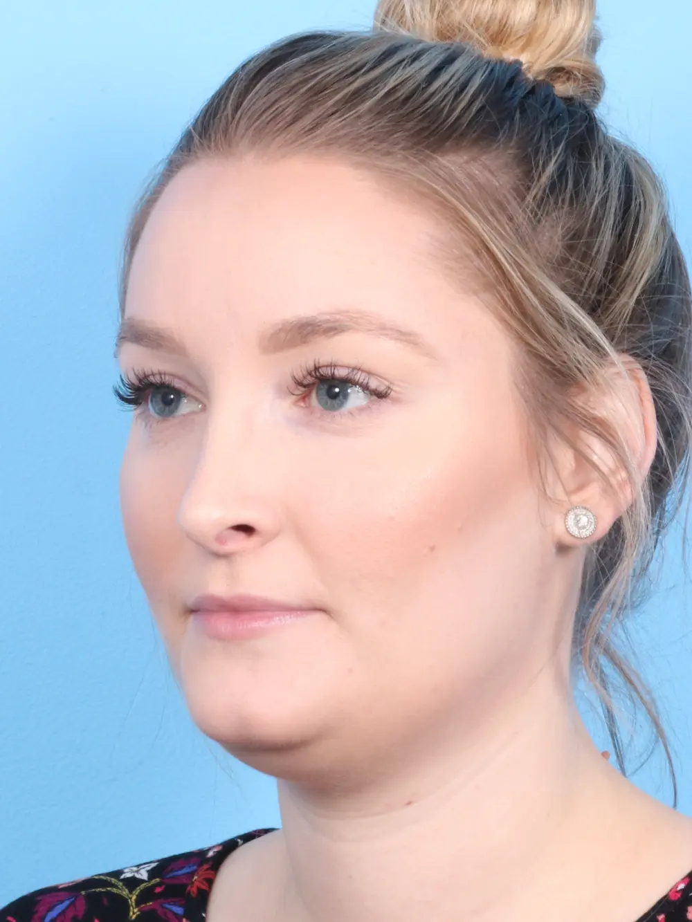 Rhinoplasty Patient Photo - Case 1831 - after view-2