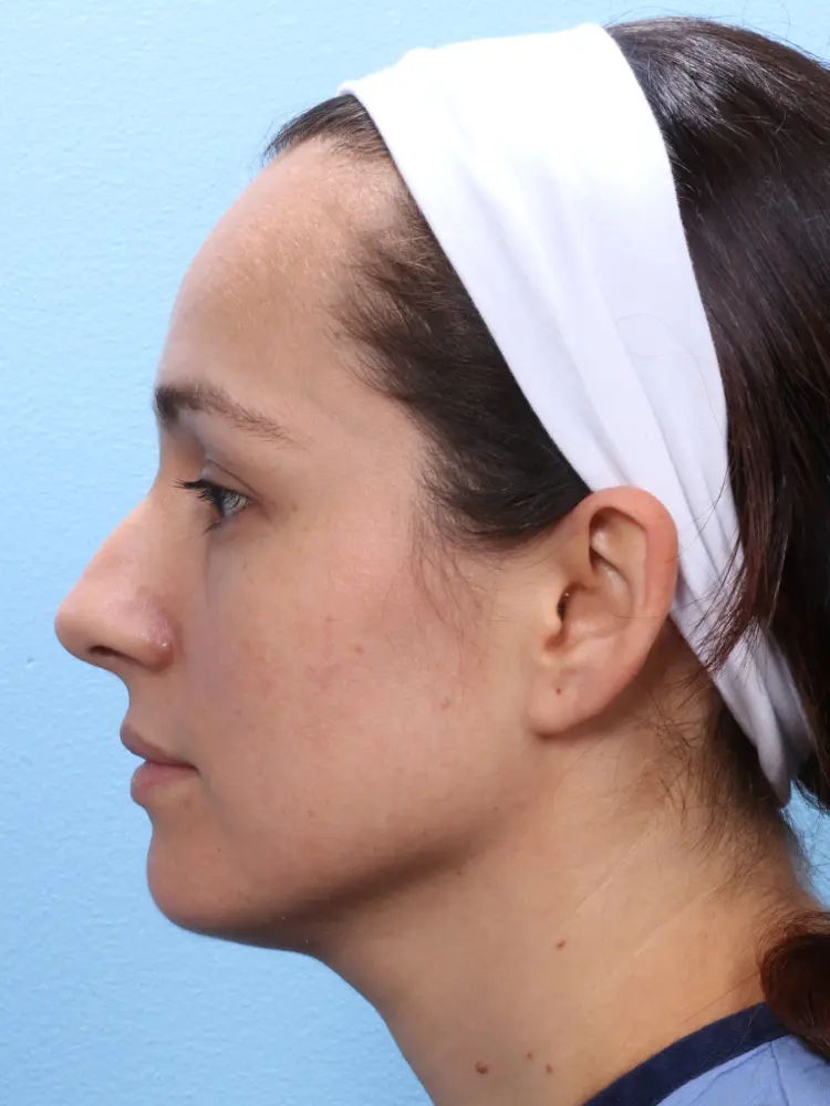 Rhinoplasty - Case 1876 - Before