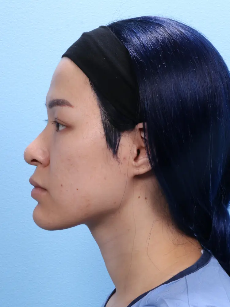 Rhinoplasty - Case 1881 - Before