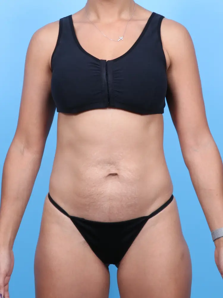 Tummy Tuck - Case 1888 - Before