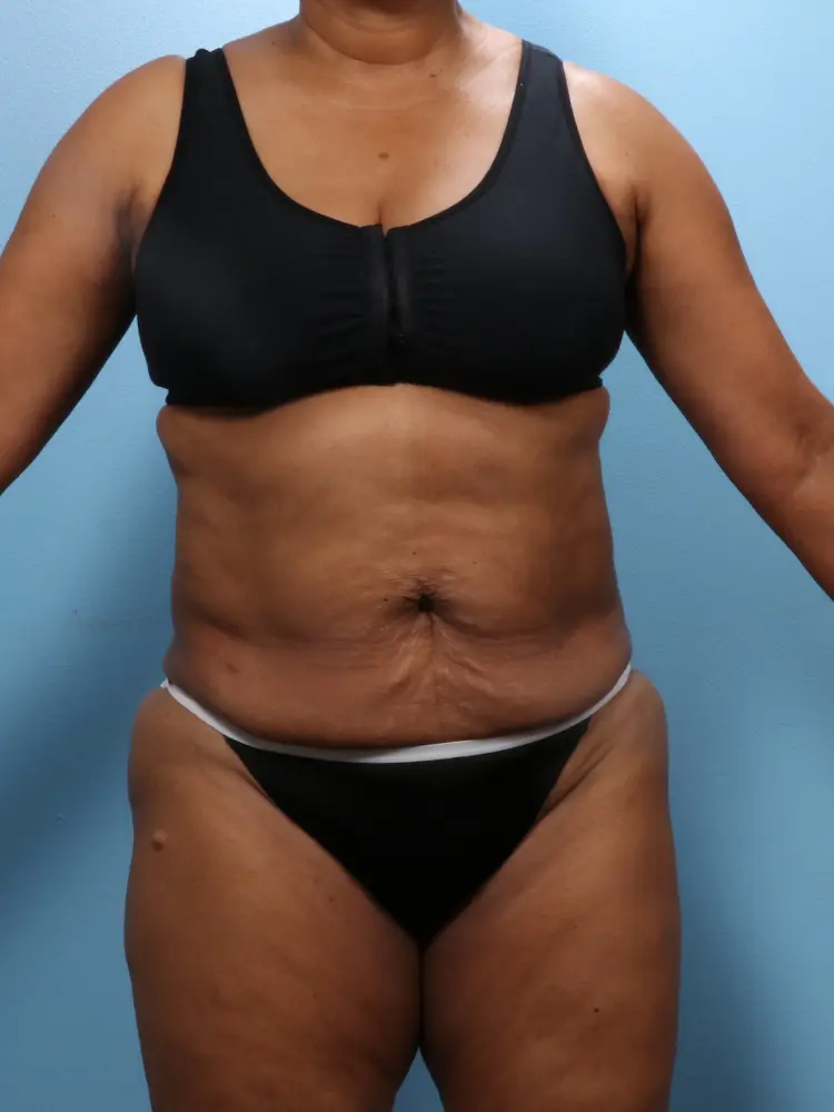 Tummy Tuck - Case 1862 - Before